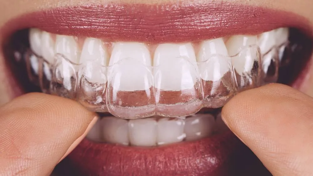 Aparelhos Fixos, Móveis e invisíveis para estética e alinhamento de mordida.